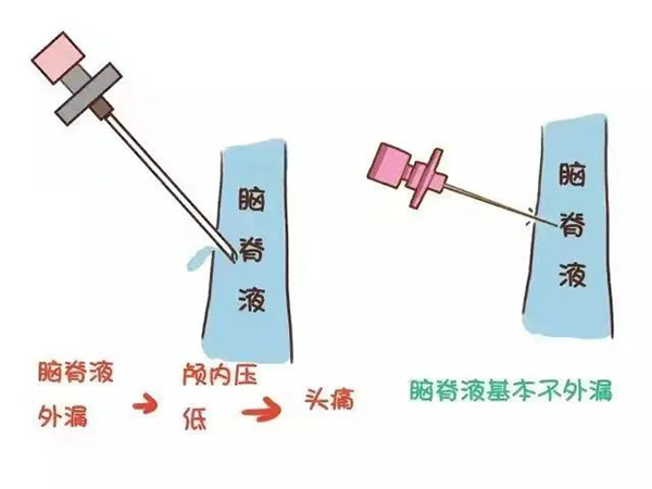 麻醉手術(shù)后不需要去枕平臥了 你知道嗎？