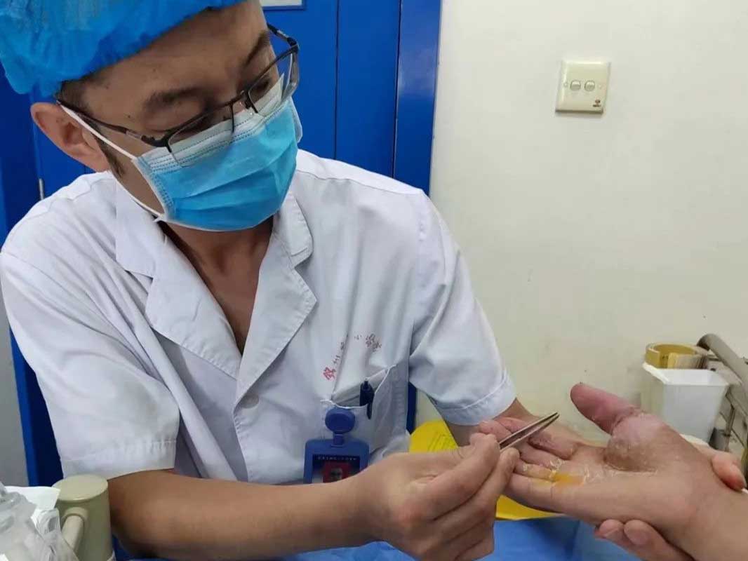 優(yōu)勢技術 | 手指離斷 成功“復活” 骨外一科手顯微外科技術成功救治拇指旋轉撕脫離斷患者