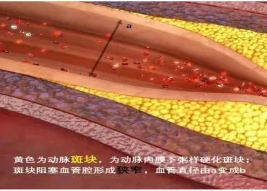 特色門診 | 頸動(dòng)脈斑塊?？崎T診