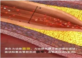 特色門診 | 頸動脈斑塊?？崎T診