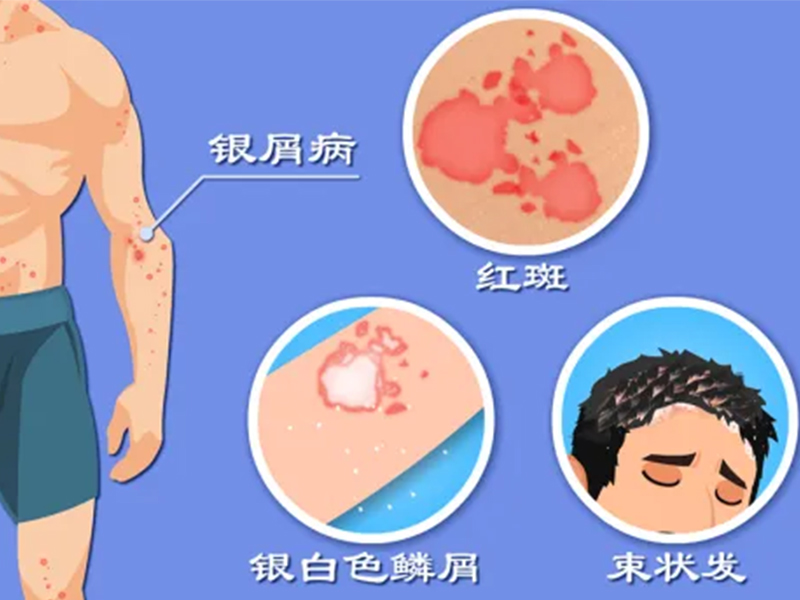 特色門診|銀屑病?？崎T診